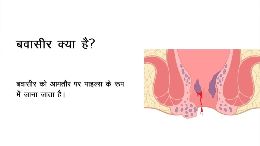 पाइल्स (बवासीर) क्या है