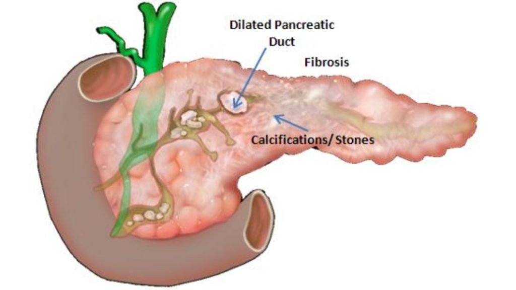 पैनक्रियास स्टोन कैसे बनता है