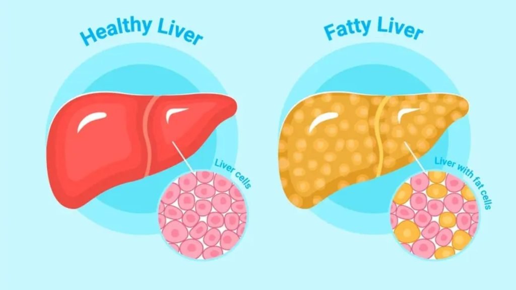 ⚠️ फैटी लिवर होने से क्या दिक्कत होती है