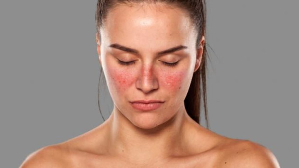 Lupus (SLE) क्या है – कारण, लक्षण और आयुर्वेदिक उपचार