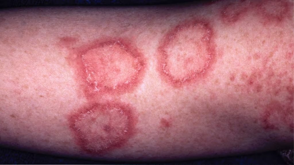 ल्यूपस (SLE) के प्रकार