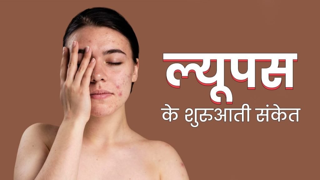 ल्यूपस के लक्षण (Symptoms)
